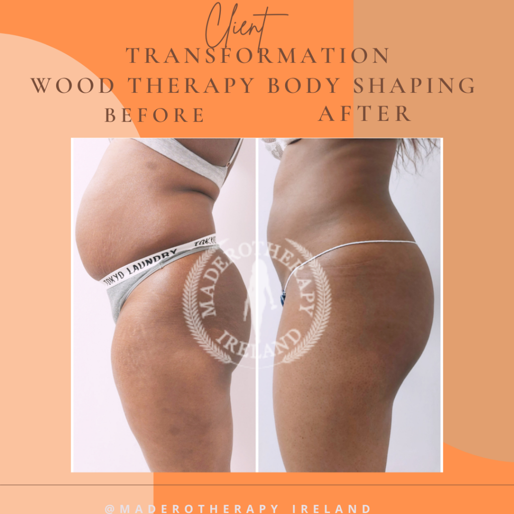 Anti-cellulite maderotherapy massages – Maderotherapy Ireland