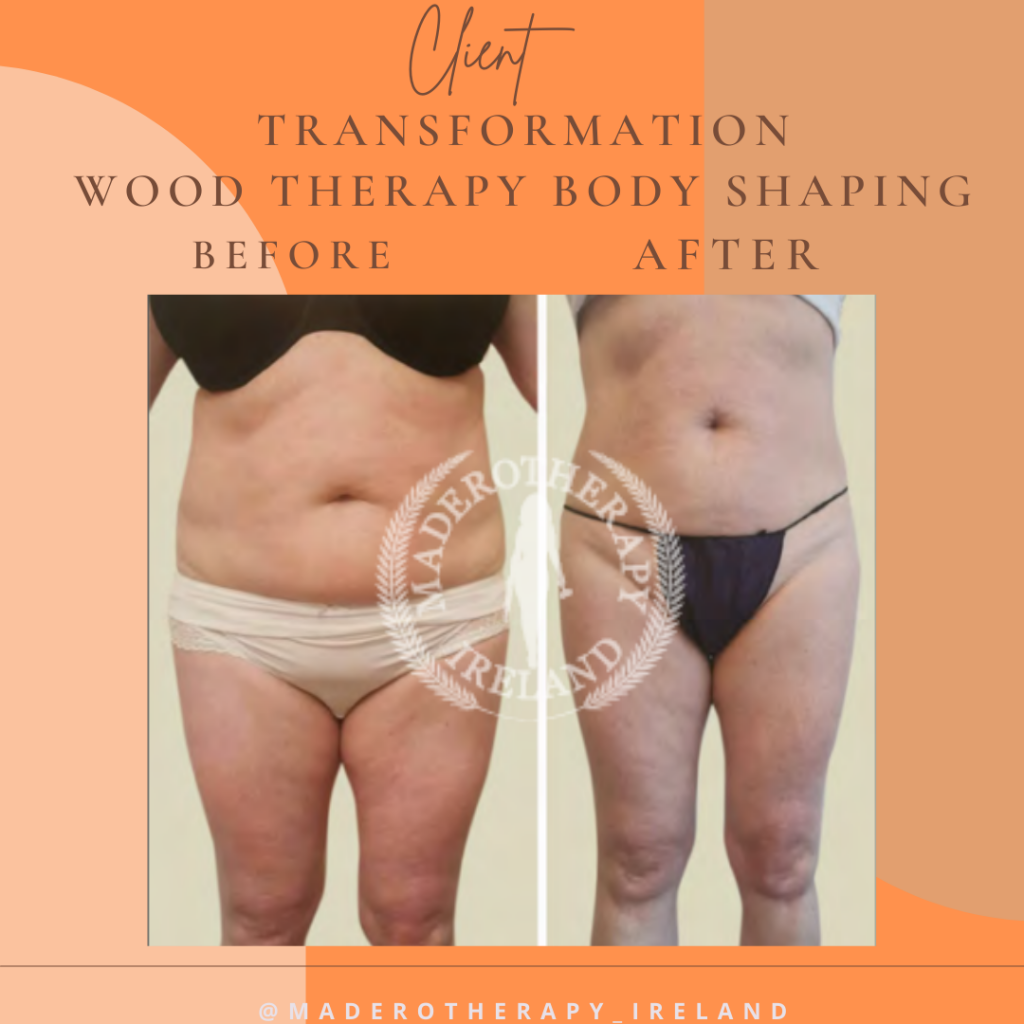 Anti-cellulite maderotherapy massages – Maderotherapy Ireland